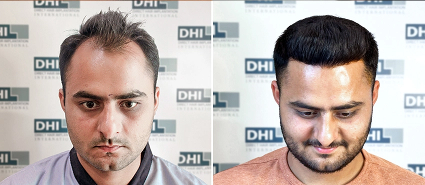 before and after hair transplant