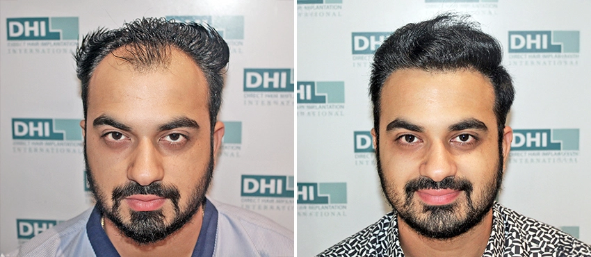 results showing before and after hair transplant treatment