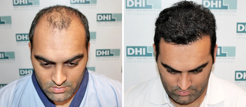 hair transplant jubilee hills