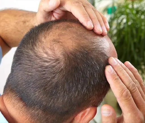 best hair transplant clinic in Gomti Nagar lucknow