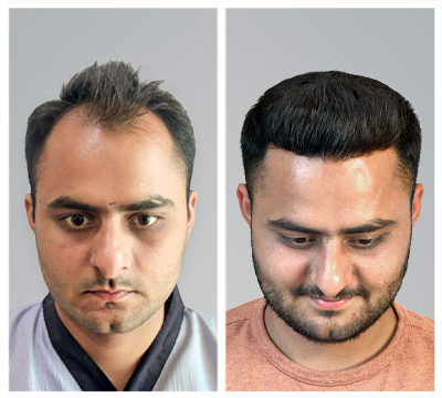 pune hair transplant clinic