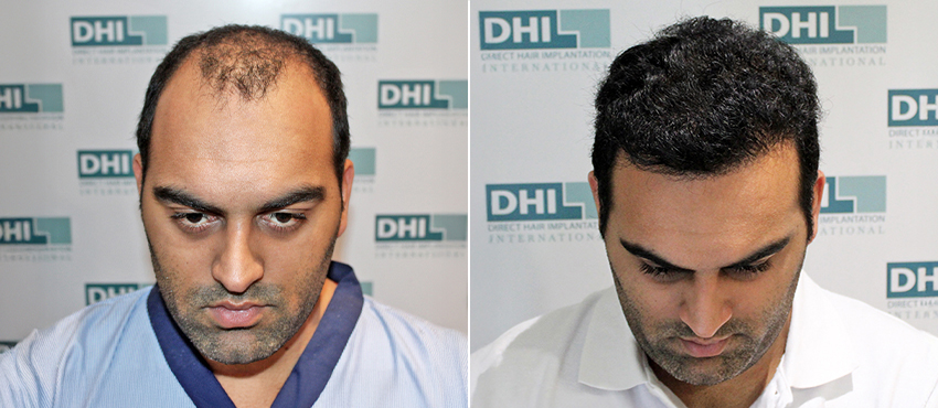 Hair transplant results in pune clinic