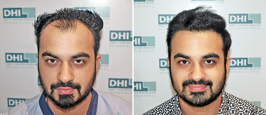 results showing before and after hair transplant treatment
