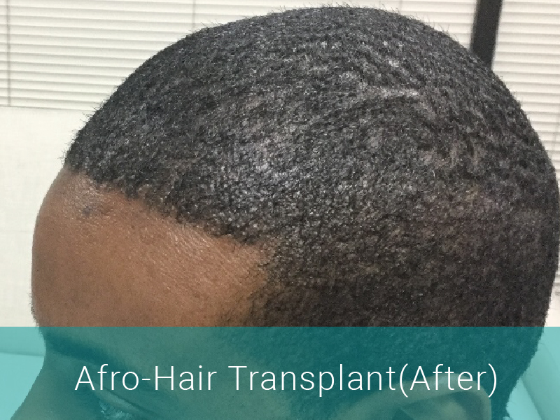 Hair Transplant Before