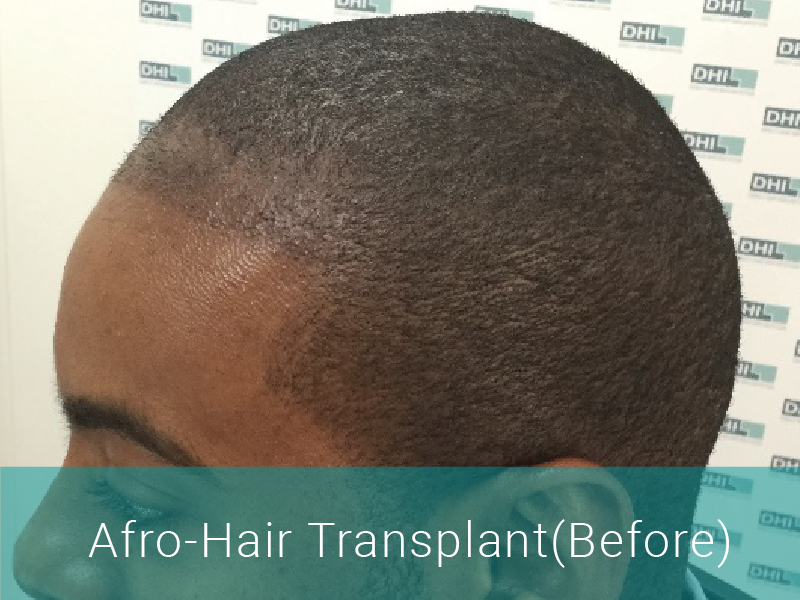 Hair Transplant Before