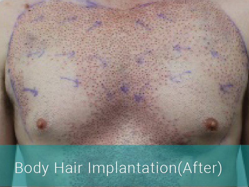 Body Hair Transplant After