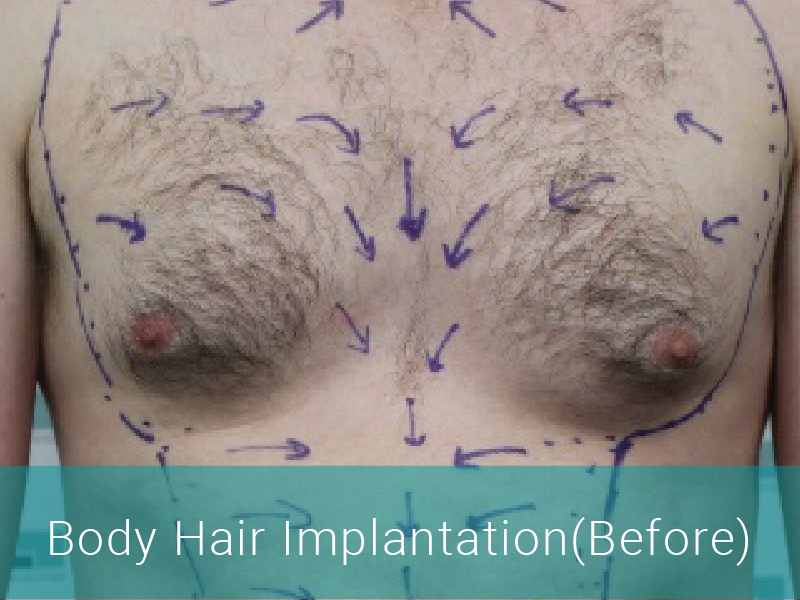 Body Hair Transplant Before