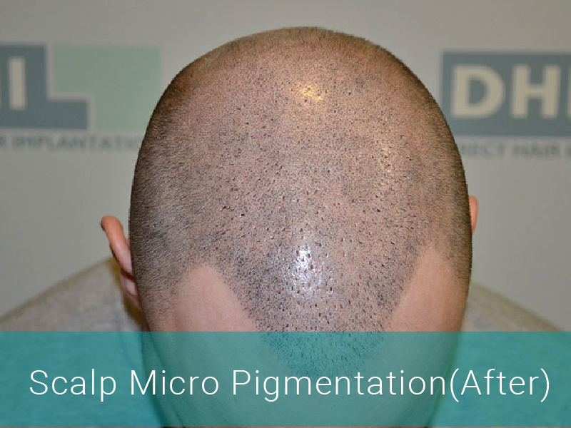 Scalp Micro Pigmentation (After)