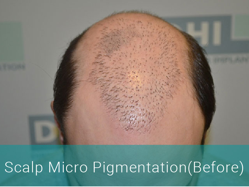 Hair Transplant Before