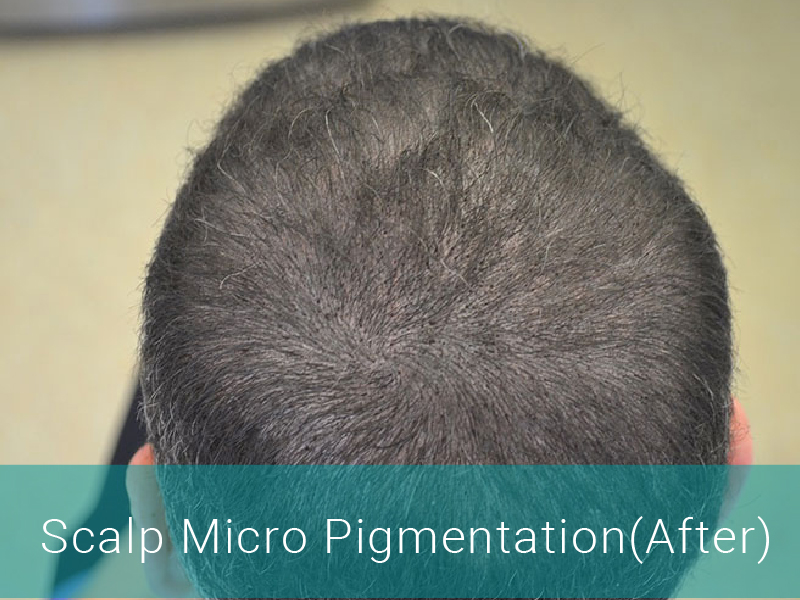 Hair Transplant Before