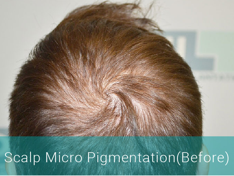 Hair Transplant Before