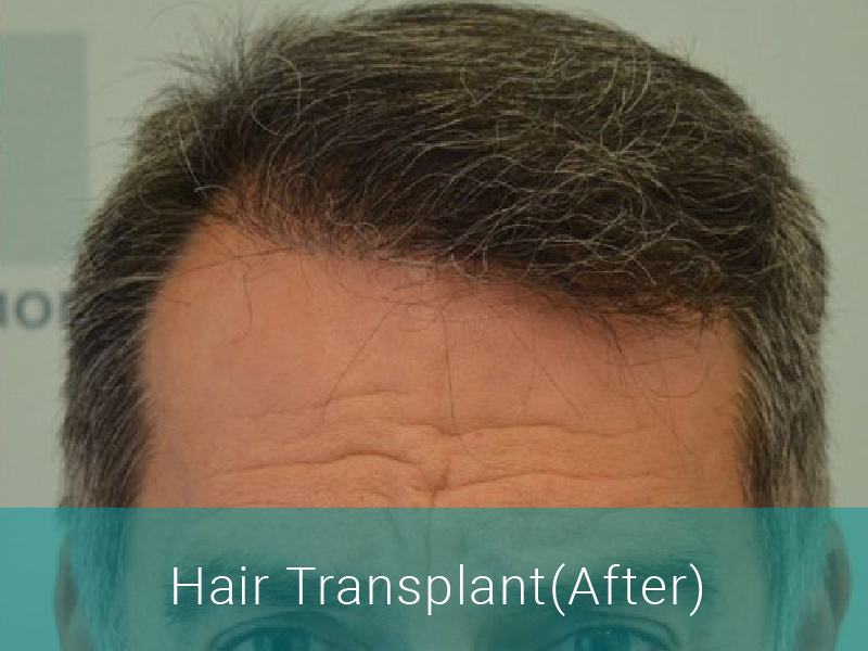 Hair Transplant After