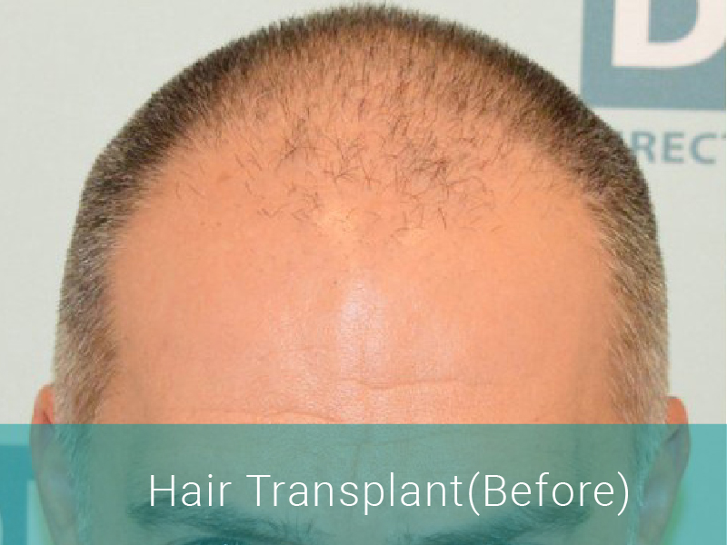 Hair Transplant Before - DHI India