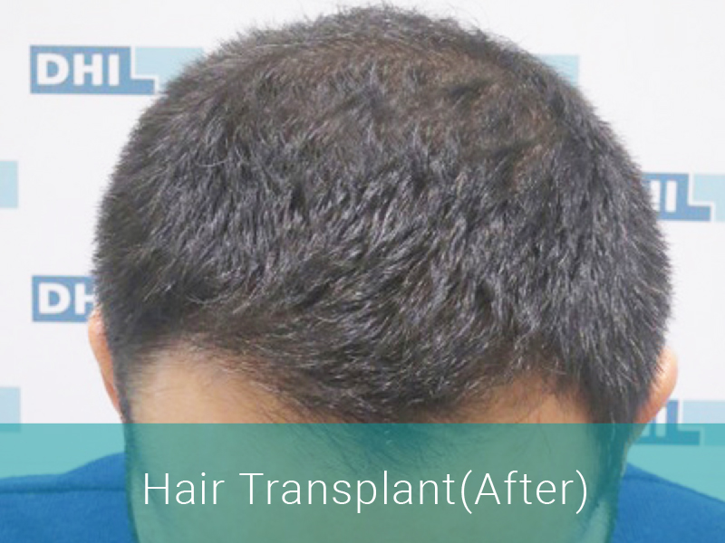 Hair Transplant After