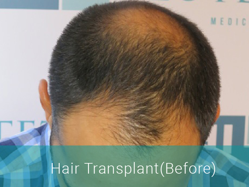 Hair Transplant Before