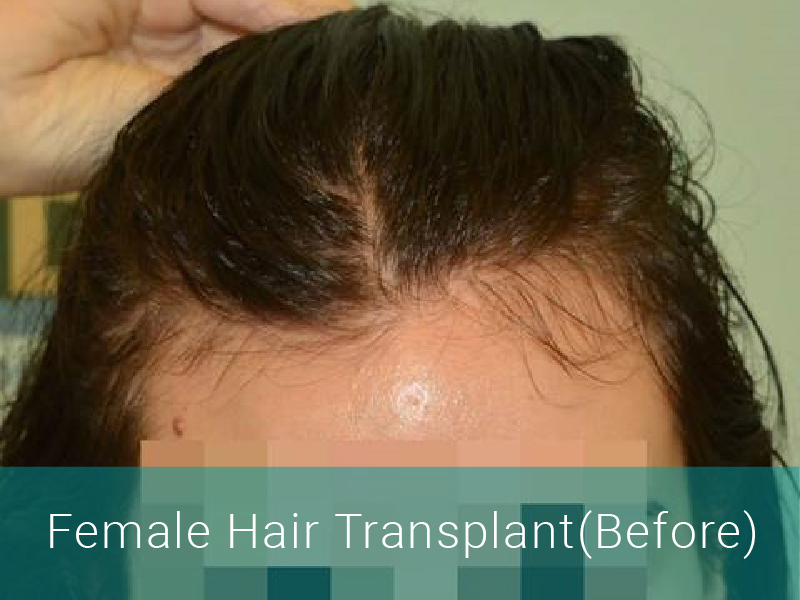Female Hair Transplant (Before)
