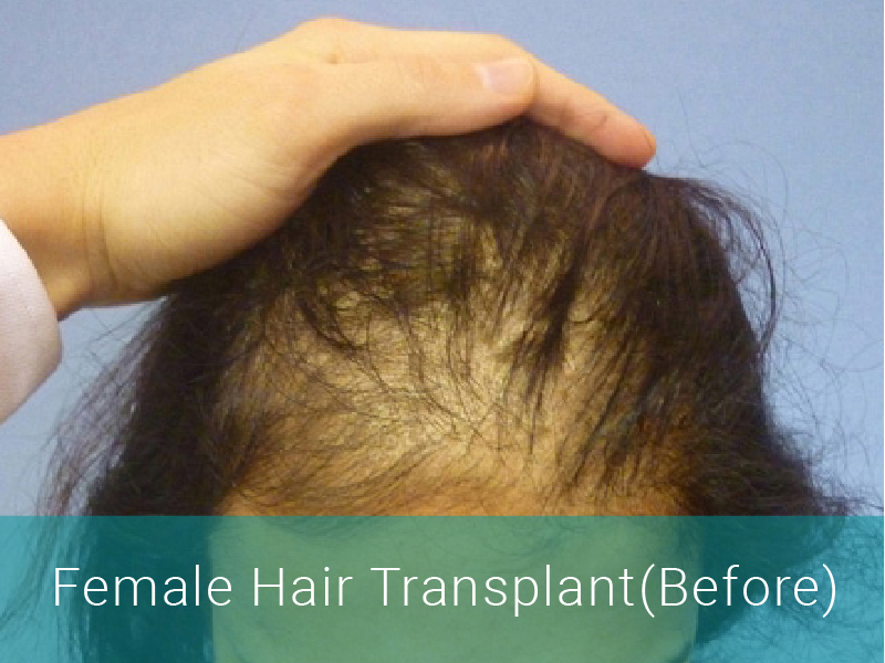 hair transplant medical tourism